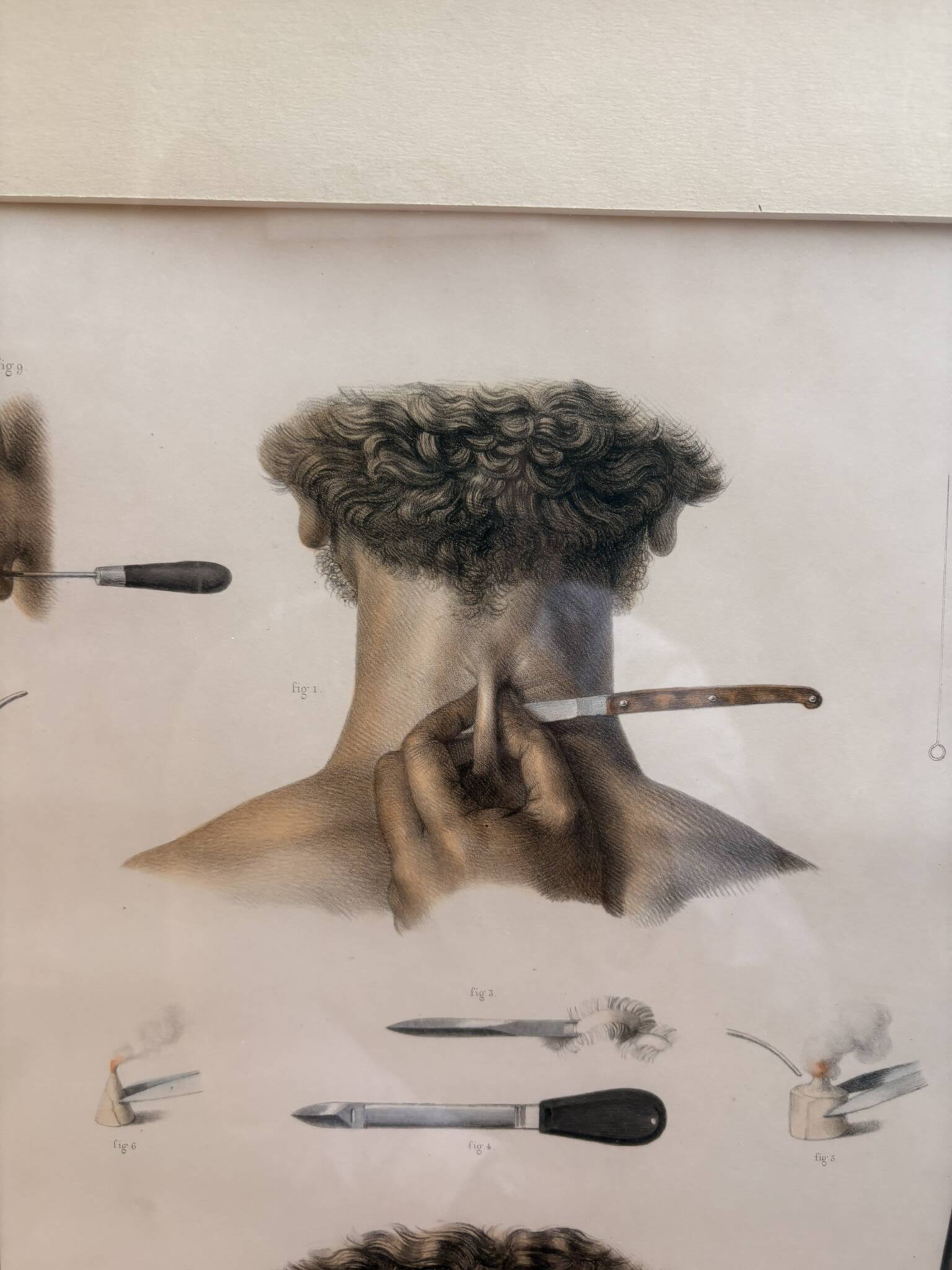 Print Engraving Material Surgery Seton Treatise Anatomy Man BOURGERY