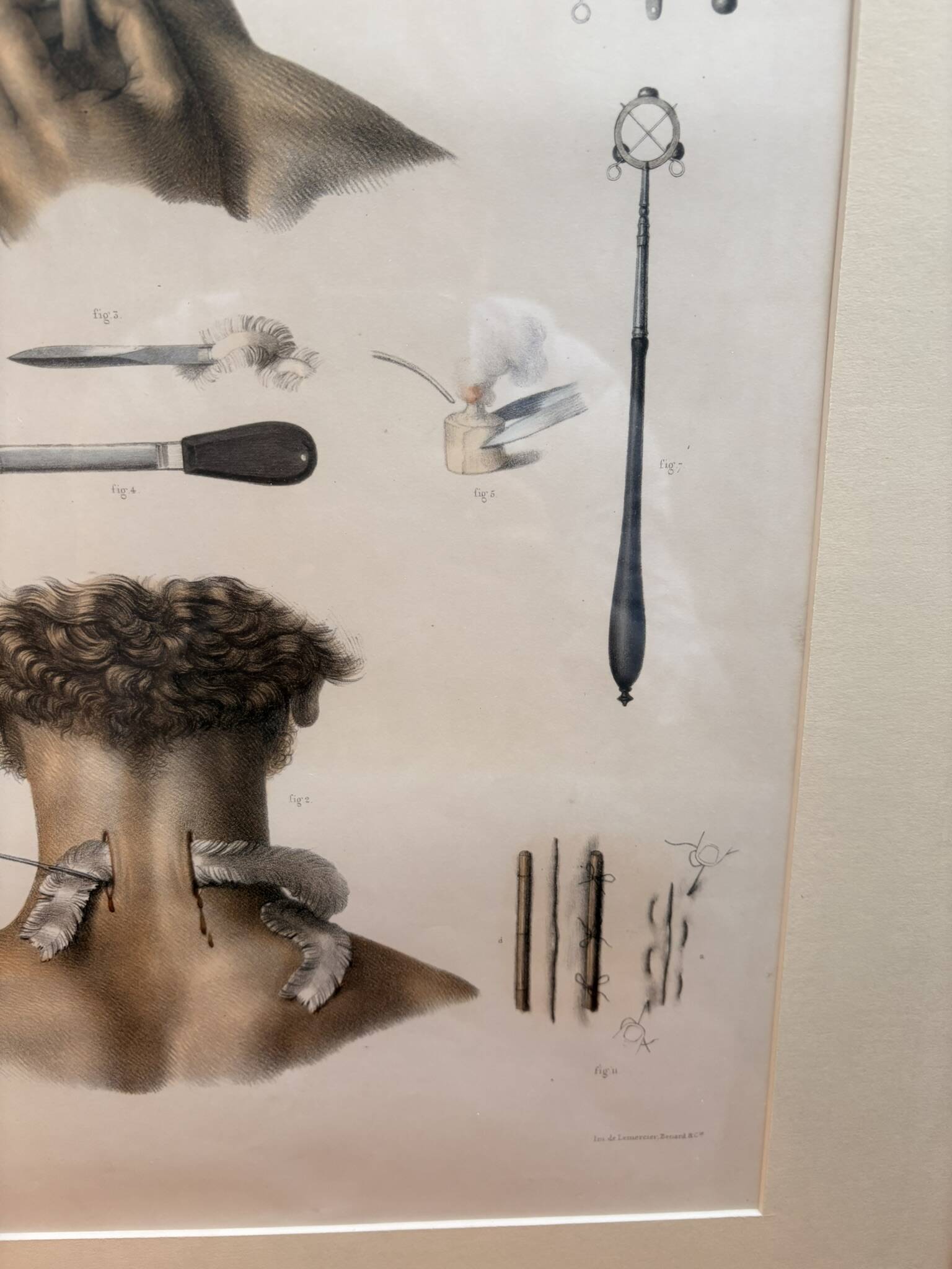 Print Engraving Material Surgery Seton Treatise Anatomy Man BOURGERY