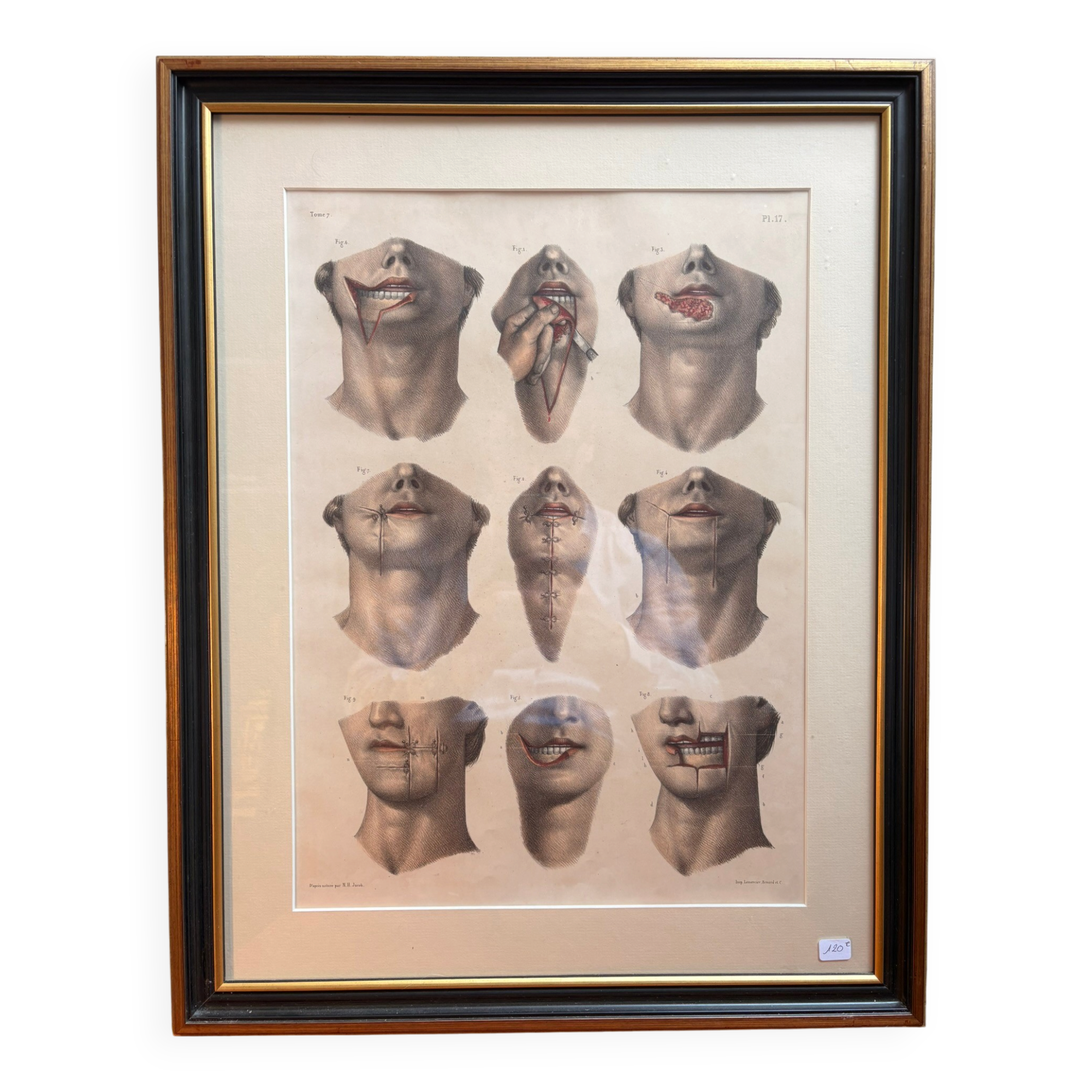 Gravure Cheiloplastic Facial Surgery Anatomy Nicolas Jacob Bourgery