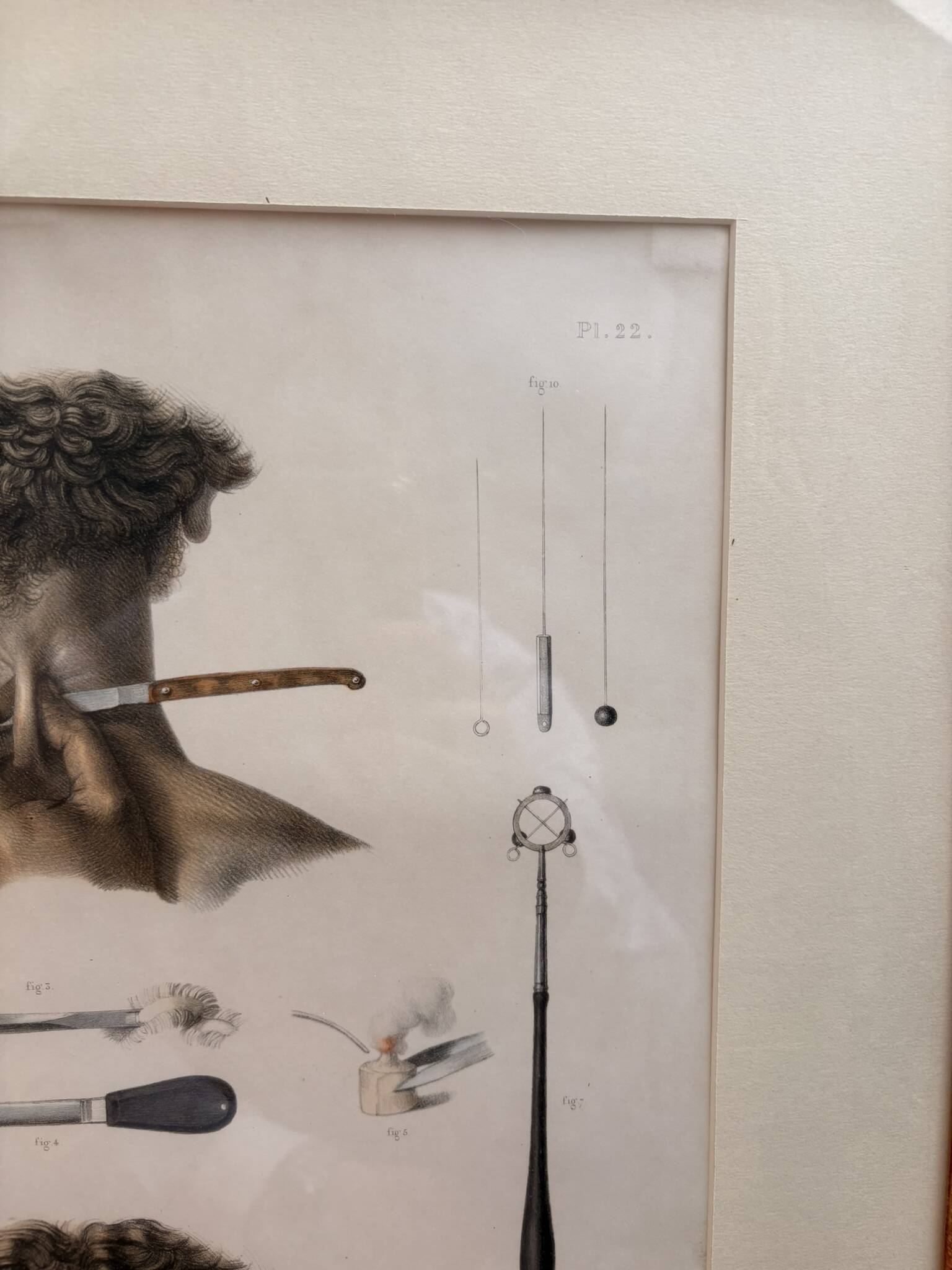 Print Engraving Material Surgery Seton Treatise Anatomy Man BOURGERY