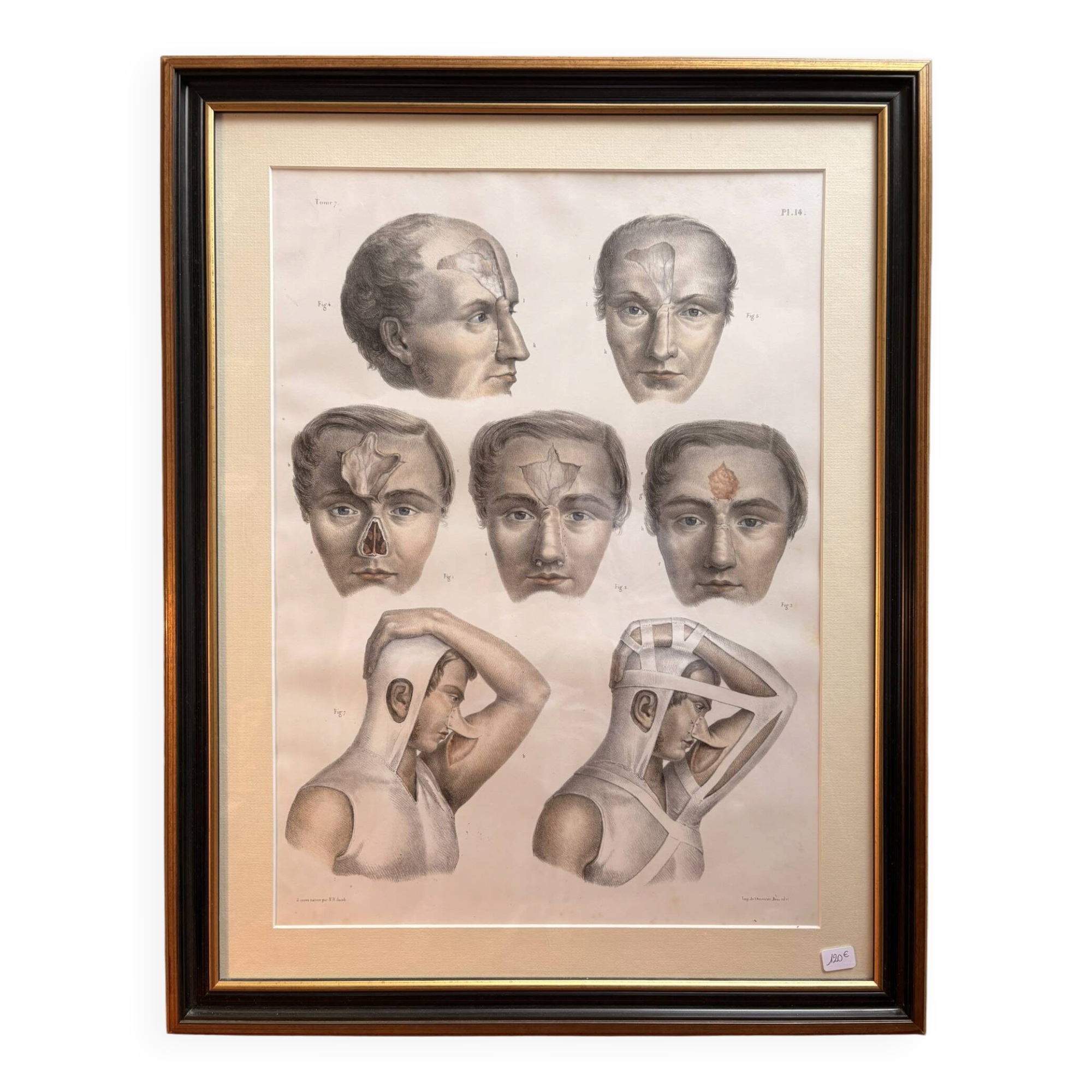 Gravure Plastic Surgery Rhinoplasty NICOLAS Jacob Bourgery Anatomy