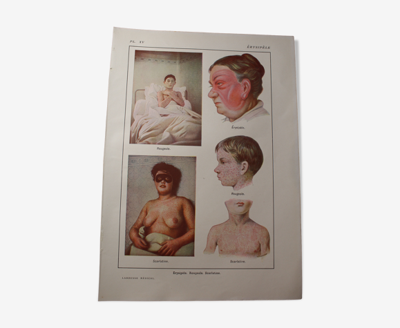 Planche medicale anatomie érysipèle