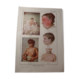 Medical board - anatomy - erysipelas