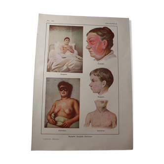 Medical board - anatomy - erysipelas