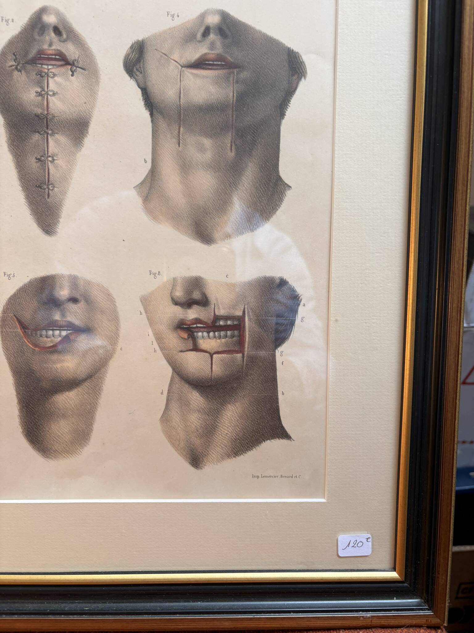 Gravure Cheiloplastic Facial Surgery Anatomy Nicolas Jacob Bourgery