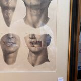 Gravure Cheiloplastic Facial Surgery Anatomy Nicolas Jacob Bourgery