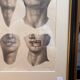 Gravure Chéiloplastique Chirurgie Faciale Anatomie Nicolas Jacob Bourgery