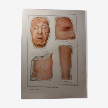 Planche médicale anatomie Urticaire
