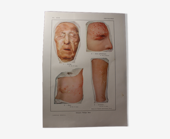 Planche médicale anatomie Urticaire