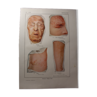 Medical board - anatomy - Urticary