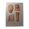 Planche médicale anatomie Urticaire