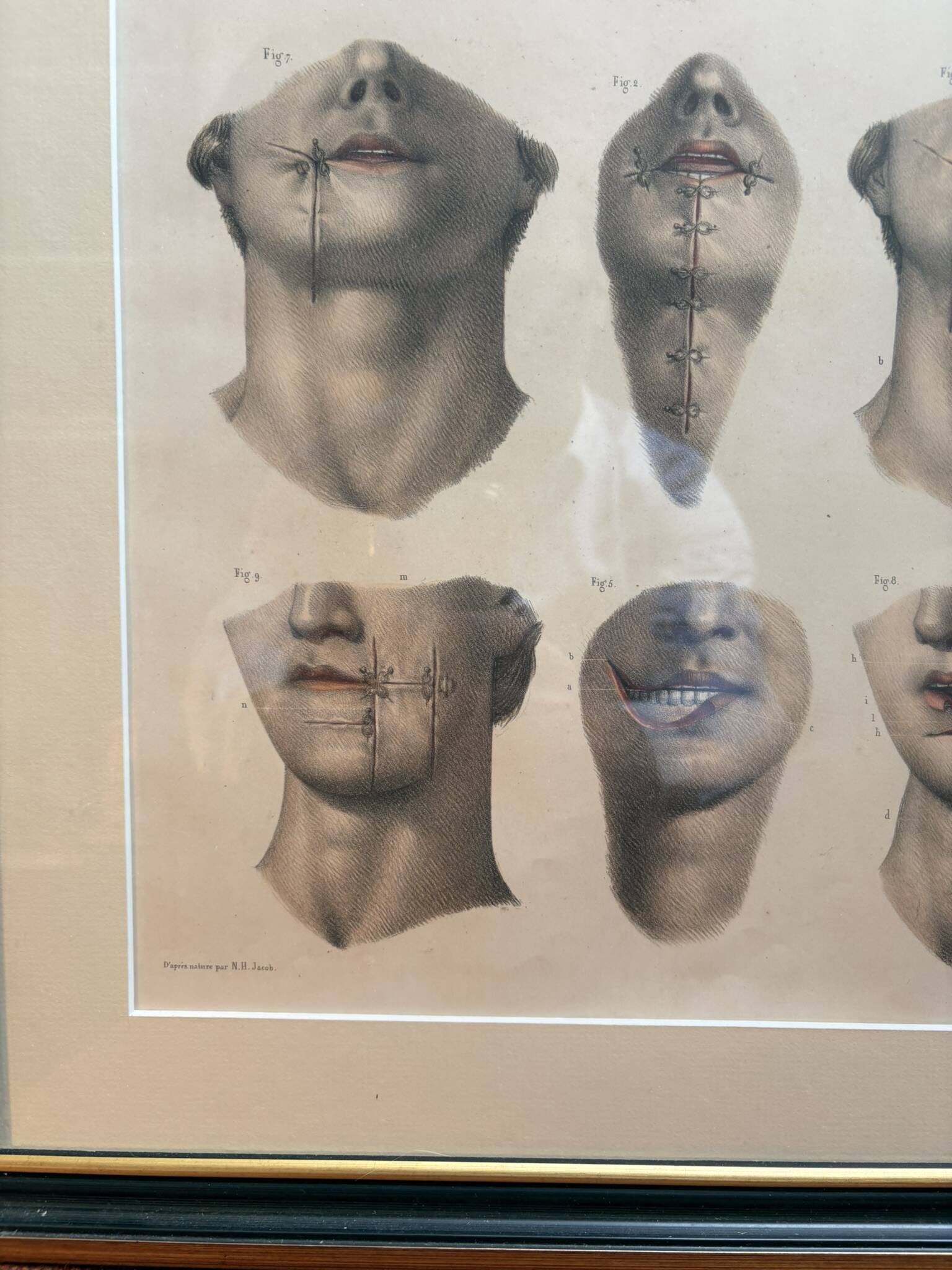 Gravure Cheiloplastic Facial Surgery Anatomy Nicolas Jacob Bourgery