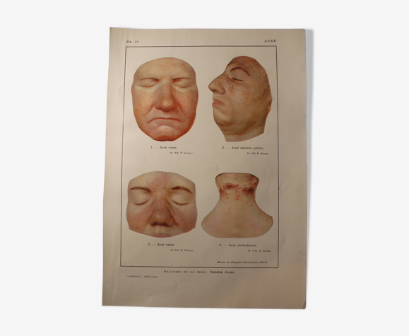 Planche médicale anatomique acné