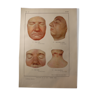 Medical board - Anatomical - Acne