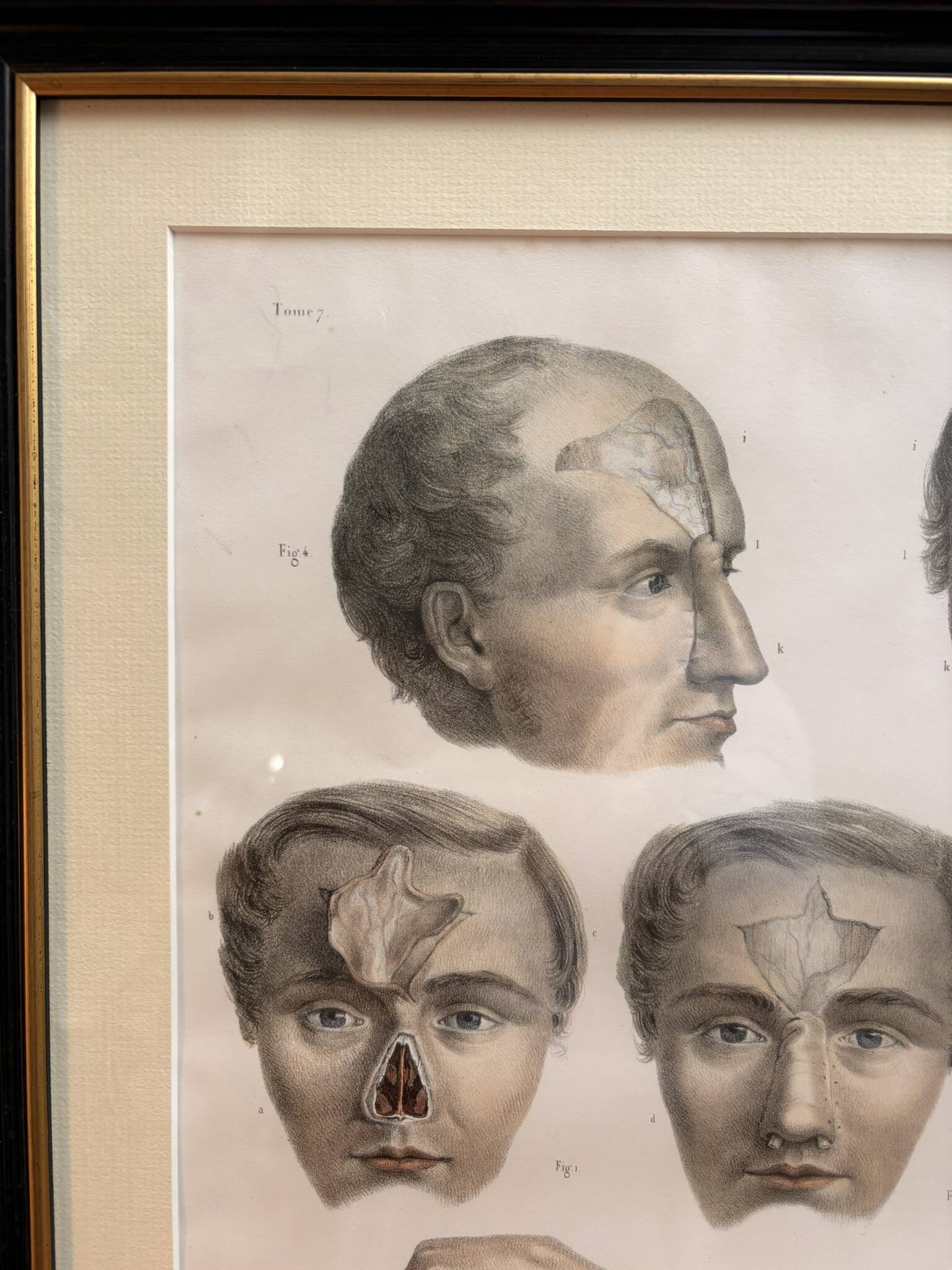 Gravure Plastic Surgery Rhinoplasty NICOLAS Jacob Bourgery Anatomy