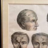 Gravure Plastic Surgery Rhinoplasty NICOLAS Jacob Bourgery Anatomy