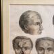 Gravure Chirurgie plastique Rhinoplastique NICOLAS Jacob Bourgery Anatomie