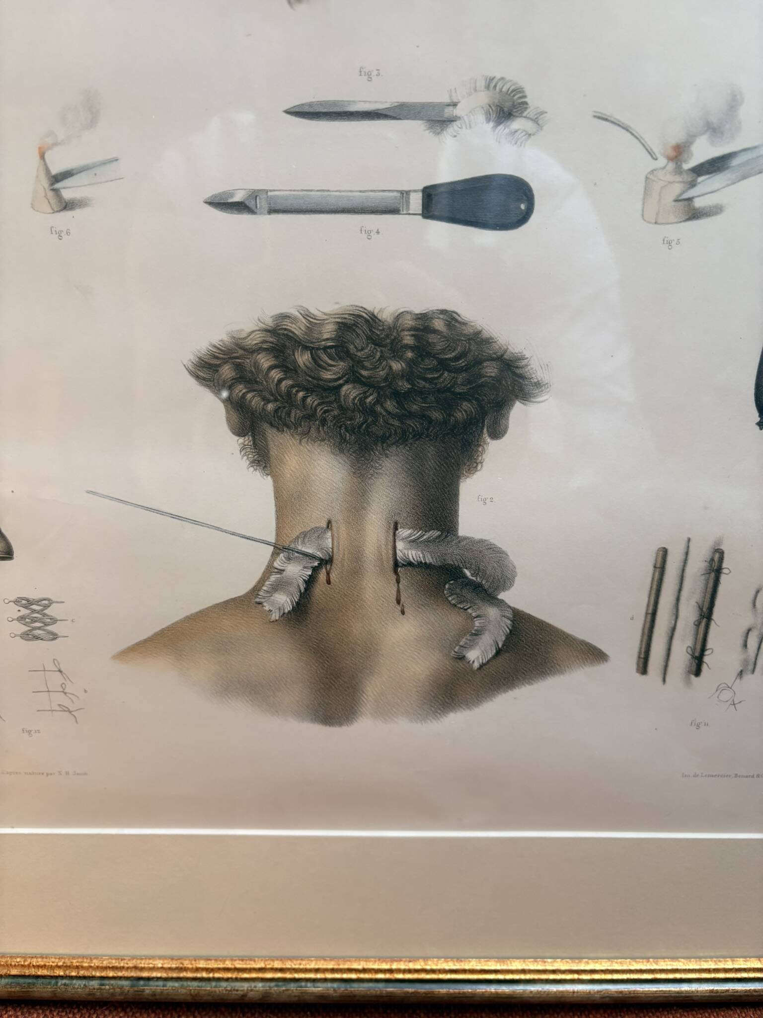 Print Engraving Material Surgery Seton Treatise Anatomy Man BOURGERY