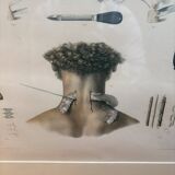 Print Engraving Material Surgery Seton Treatise Anatomy Man BOURGERY