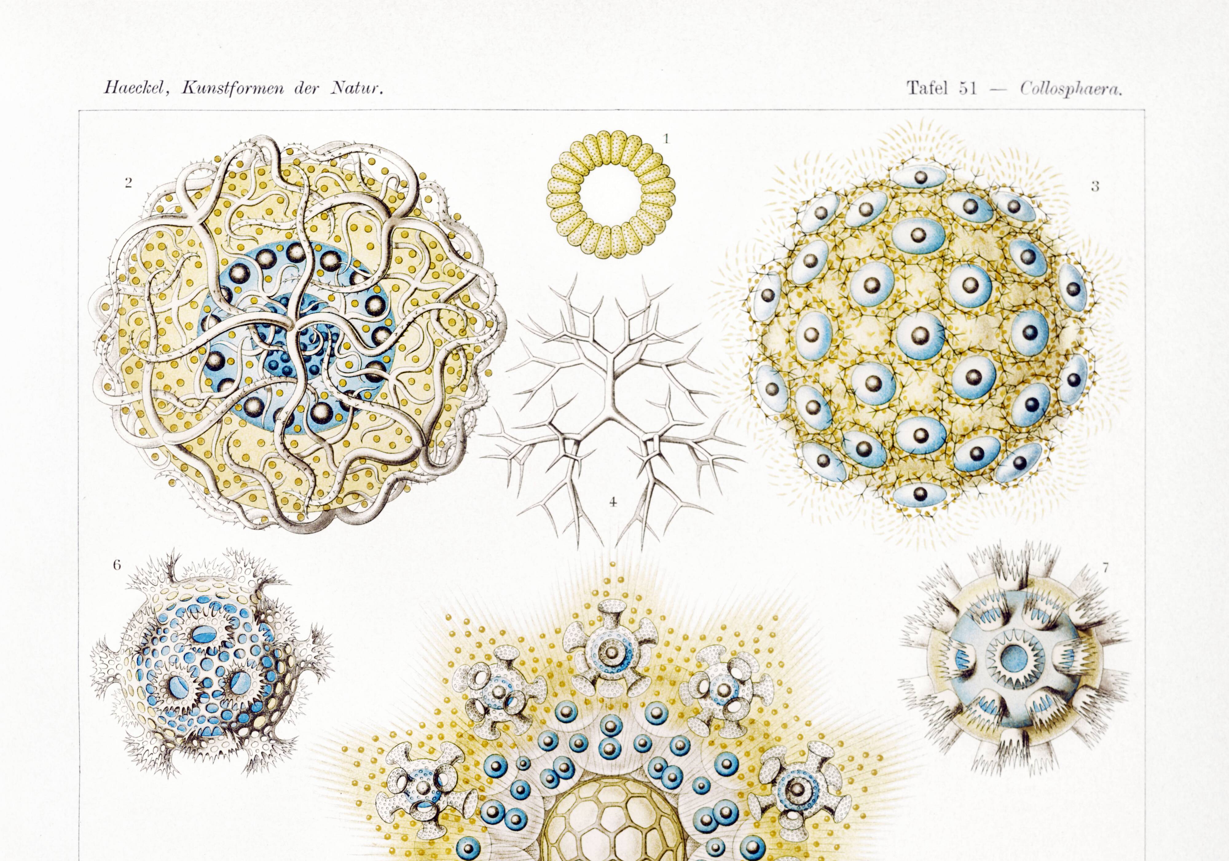 Poster about polycystic kidney stones, based on an old lithograph from 1904.