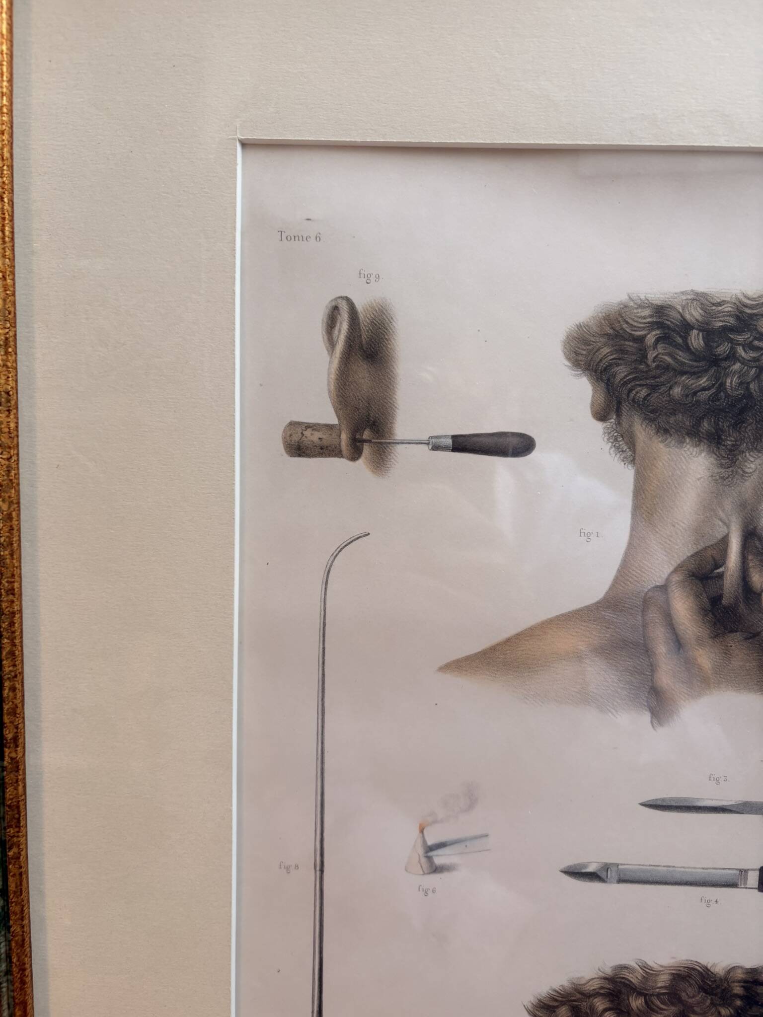 Print Engraving Material Surgery Seton Treatise Anatomy Man BOURGERY