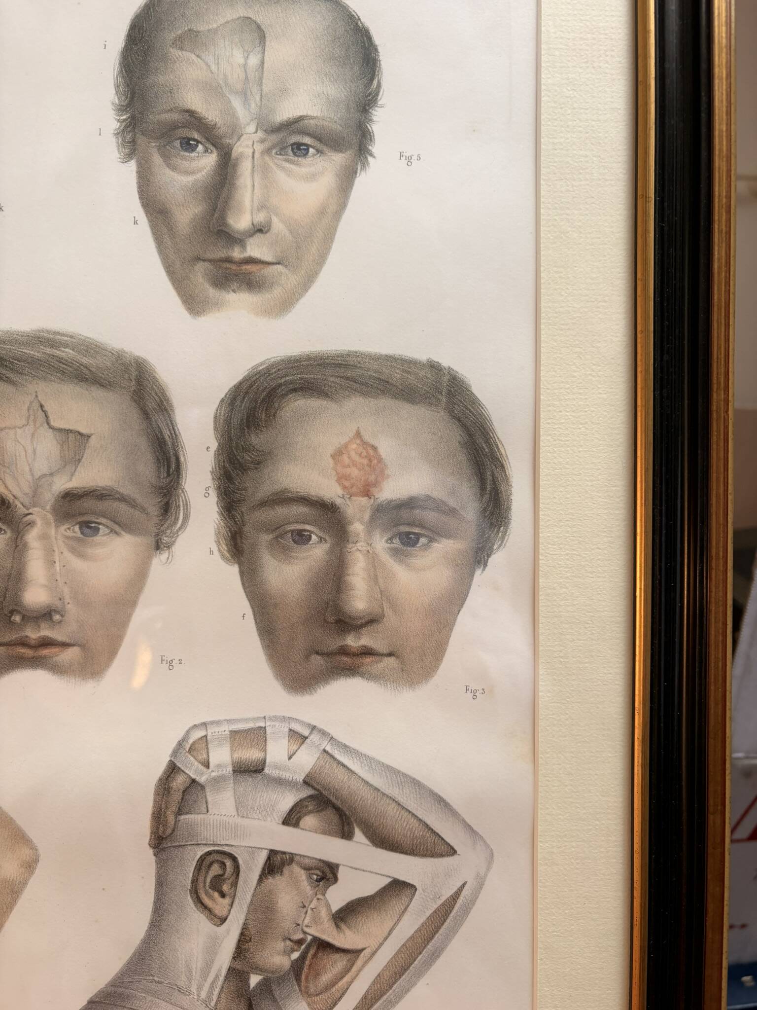 Gravure Plastic Surgery Rhinoplasty NICOLAS Jacob Bourgery Anatomy