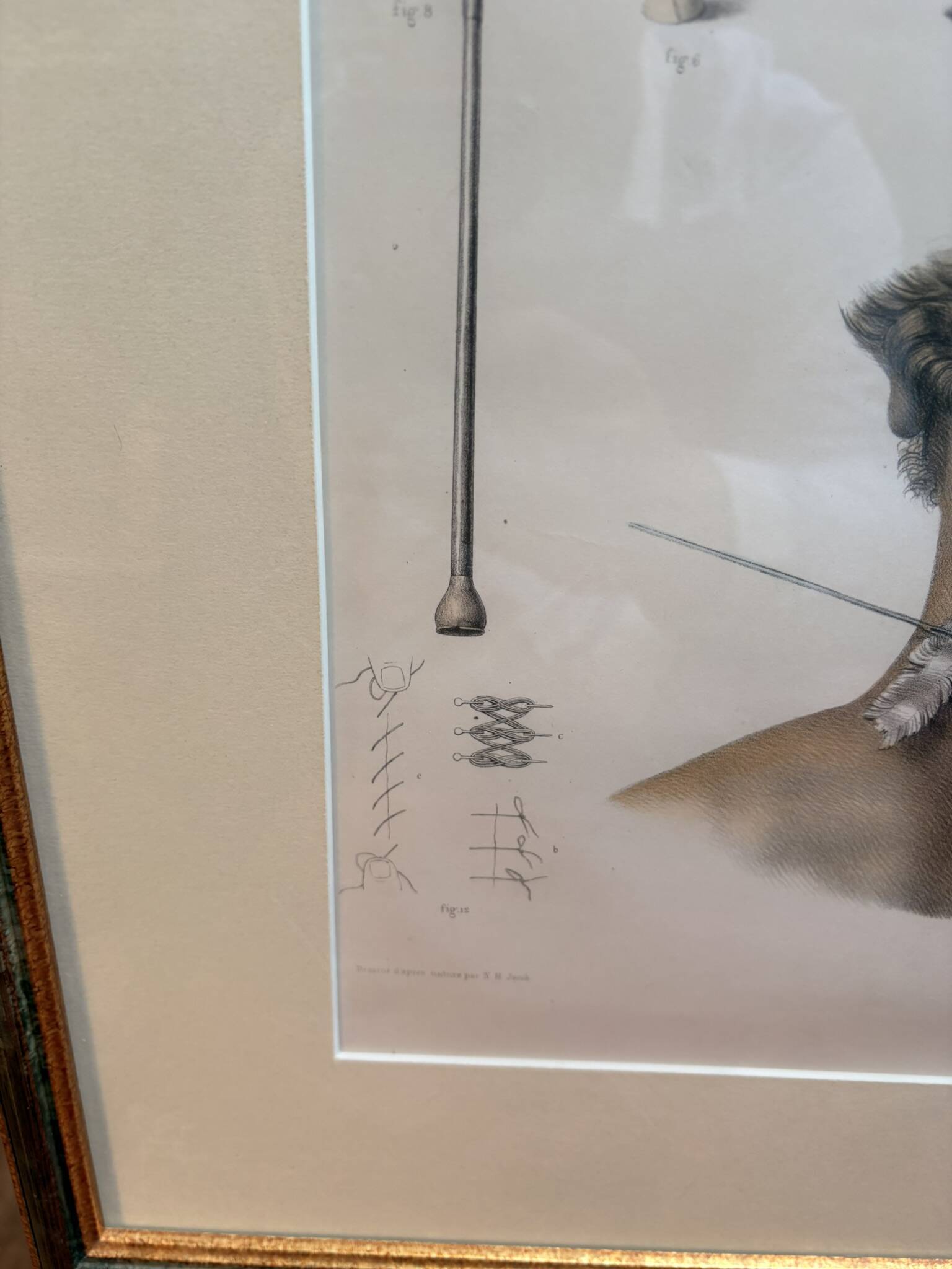 Print Engraving Material Surgery Seton Treatise Anatomy Man BOURGERY