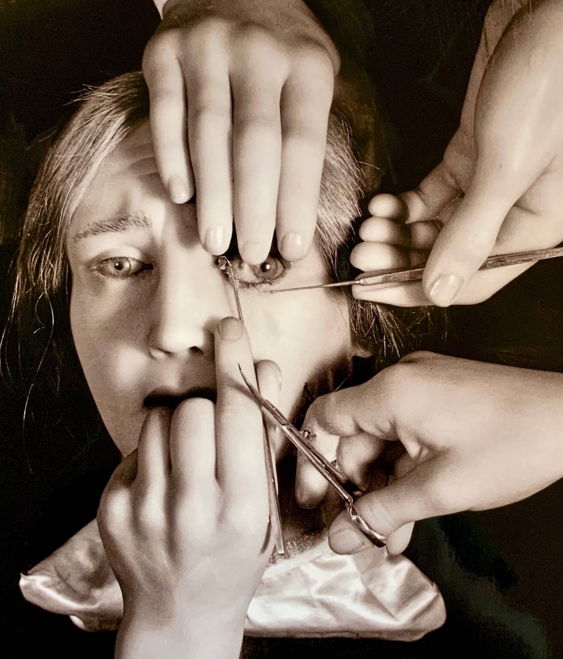 “Schielens Operation (Squint Surgery)” – 1944 Art Photo