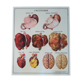 Old vintage school poster nightingale 60s liver alcoholism eye vision