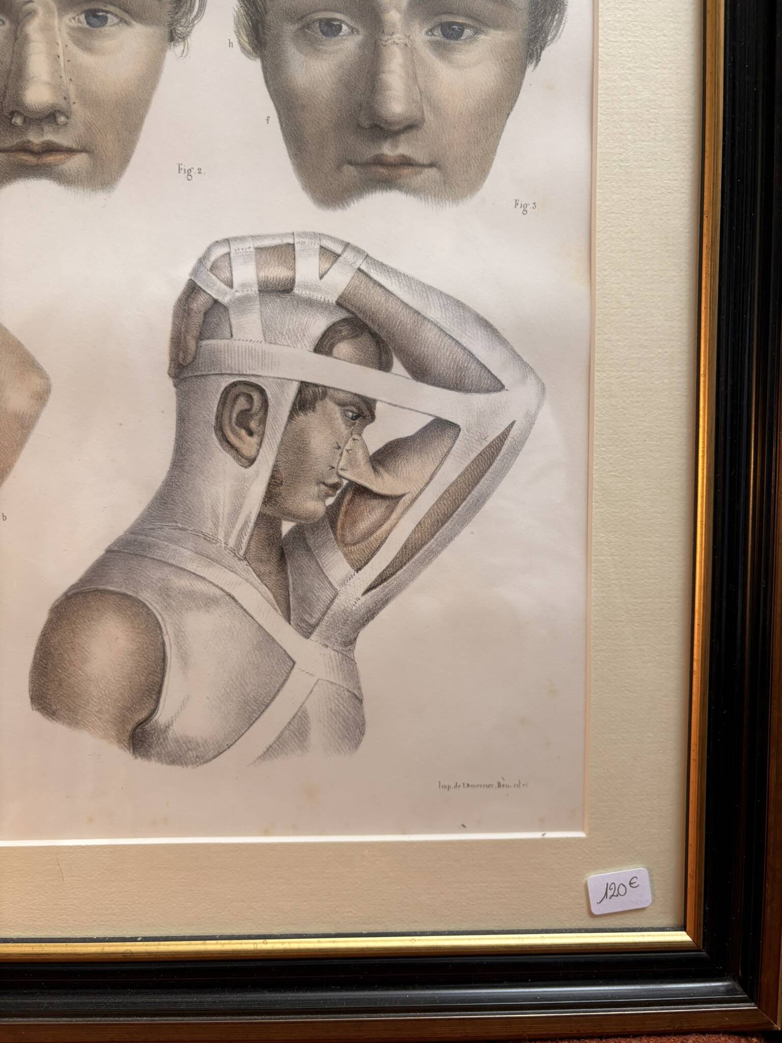 Gravure Plastic Surgery Rhinoplasty NICOLAS Jacob Bourgery Anatomy