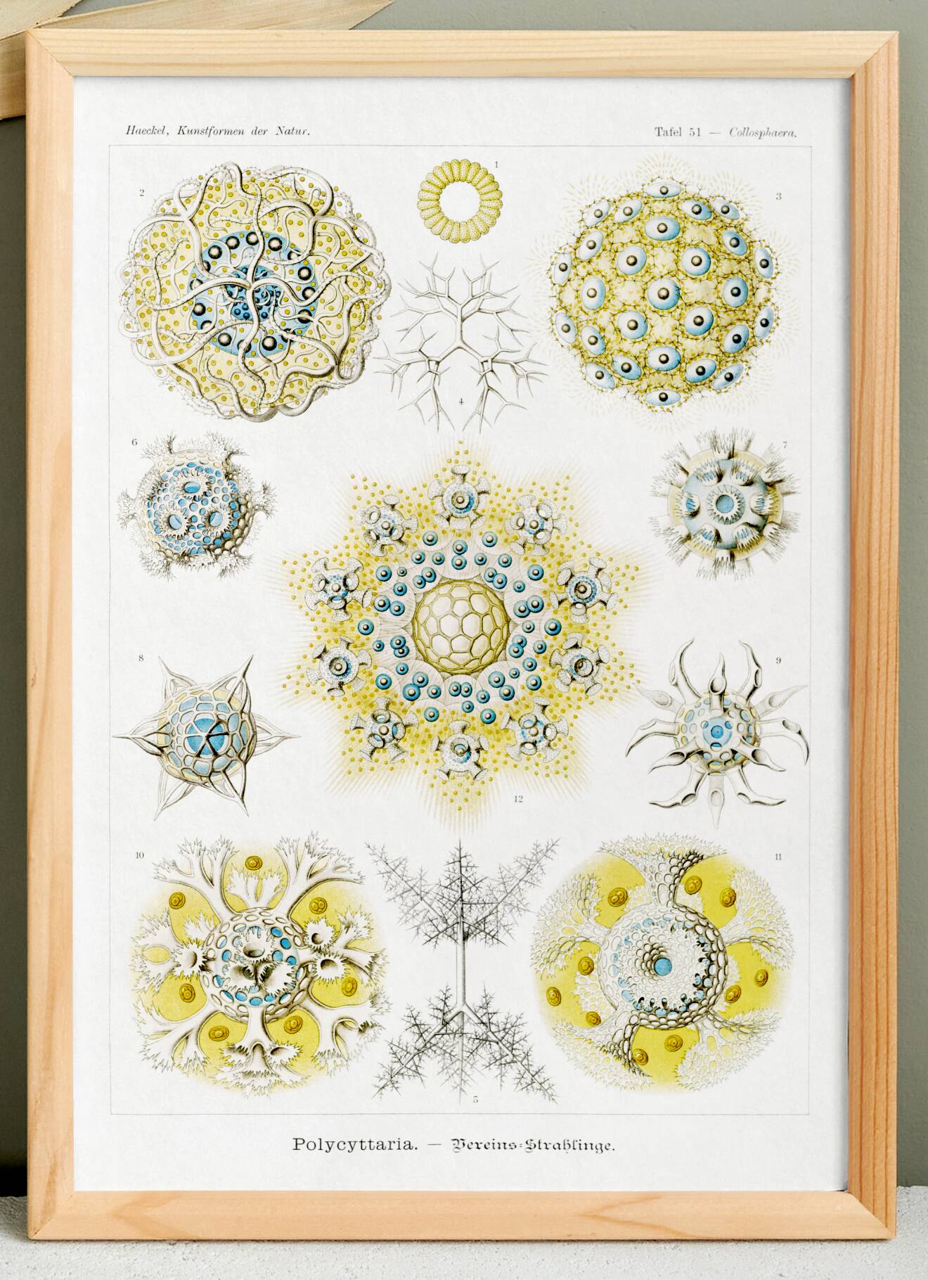 Poster about polycystic kidney stones, based on an old lithograph from 1904.