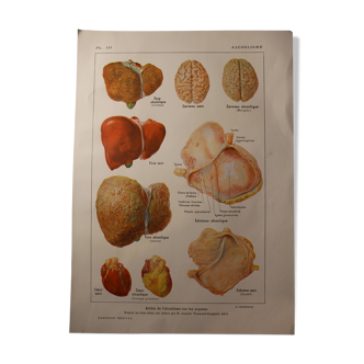 Medical board -Anatomical - Alcoholism