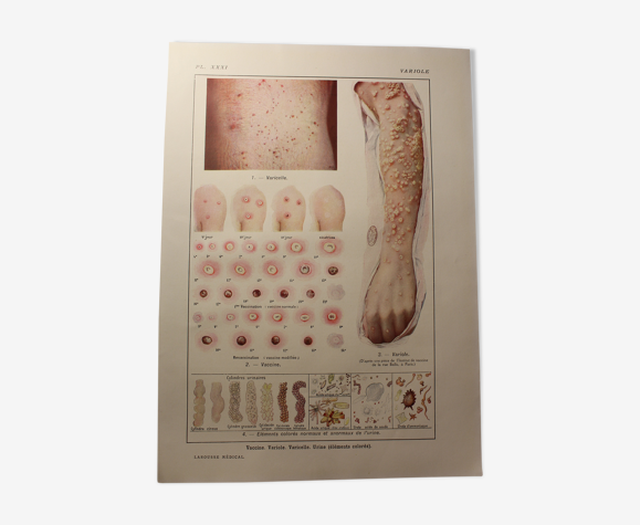 Planche médicale anatomie Variole