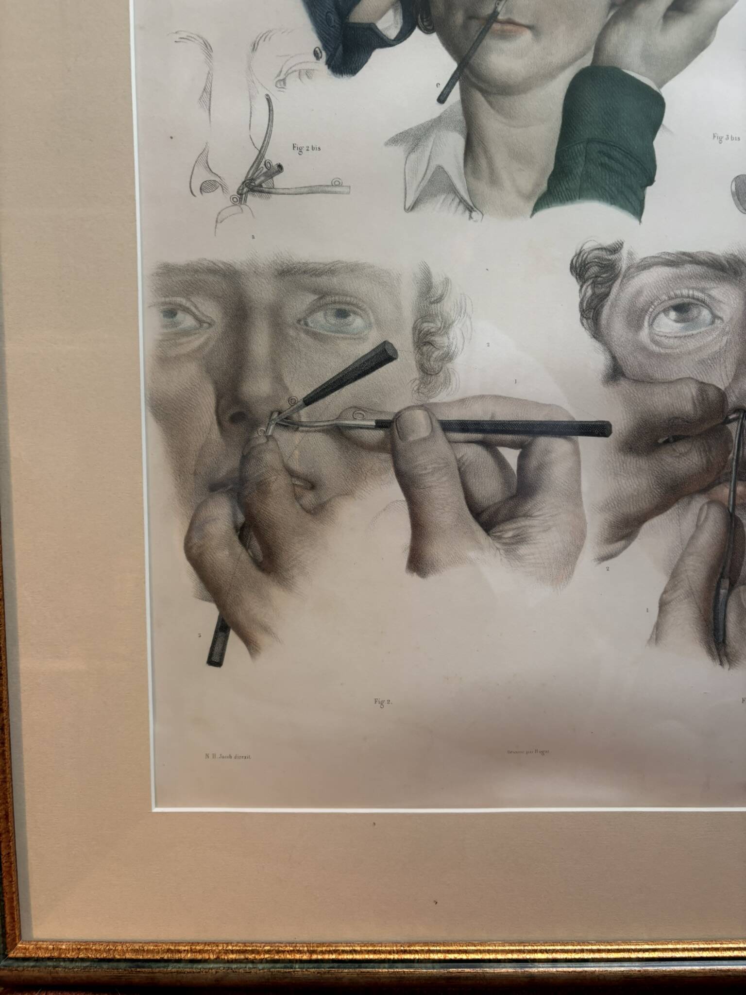 Old Print Engraving 19th Century Anatomy Surgery Atlas Bourgery Nicolas Jacob