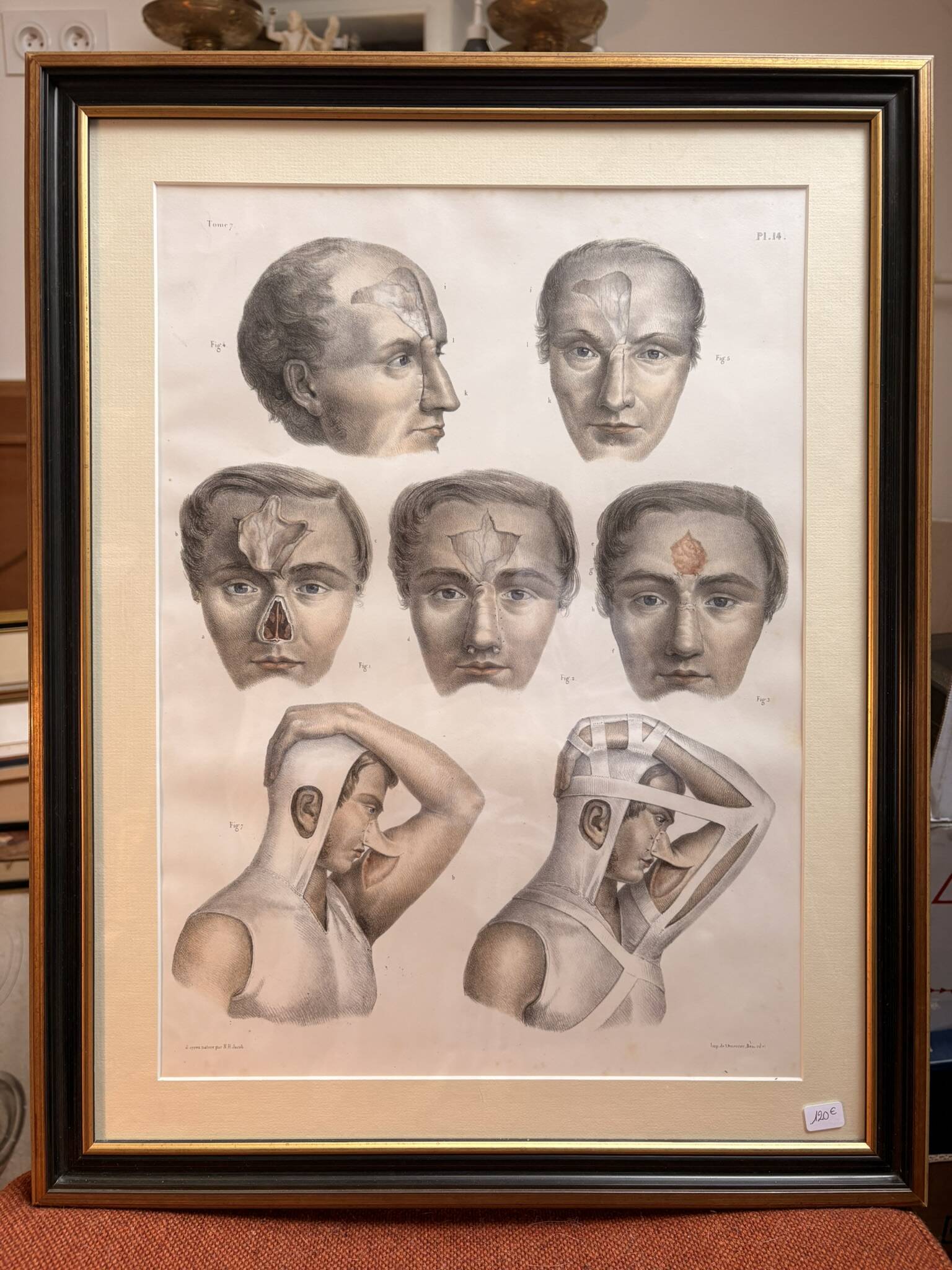 Gravure Plastic Surgery Rhinoplasty NICOLAS Jacob Bourgery Anatomy