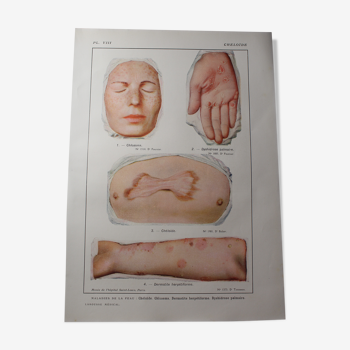 Planche médicale anatomie Chéloïde