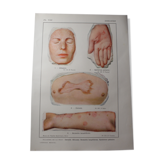 Planche médicale anatomie Chéloïde