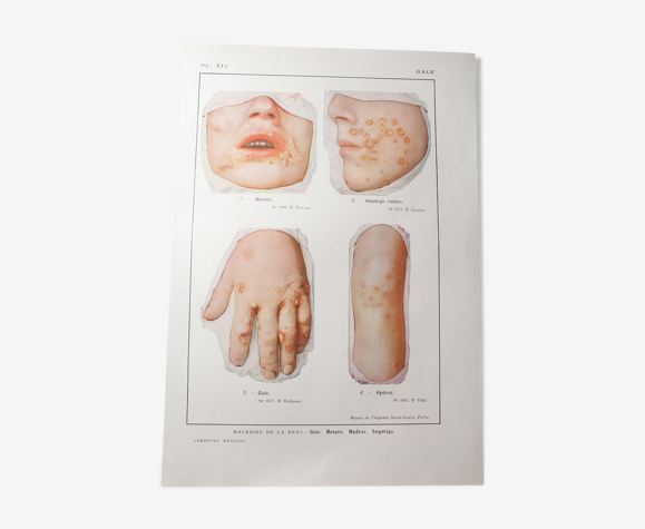 Planche médicale anatomie Gale