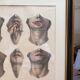 Gravure Chéiloplastique Chirurgie Faciale Anatomie Nicolas Jacob Bourgery