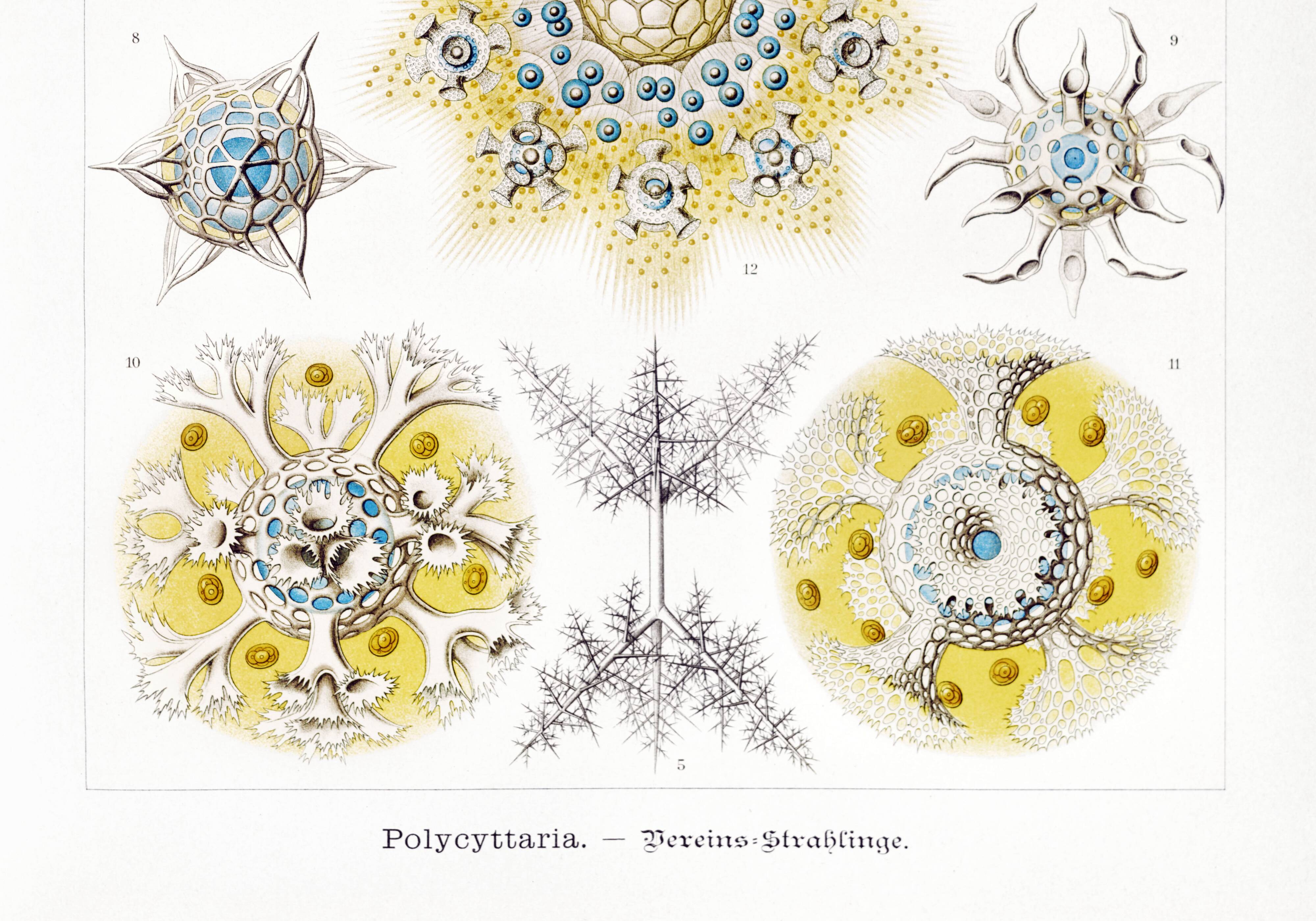 Poster about polycystic kidney stones, based on an old lithograph from 1904.