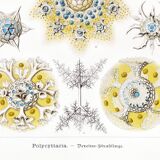 Poster about polycystic kidney stones, based on an old lithograph from 1904.