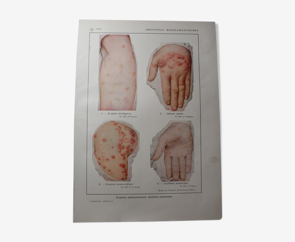 Planche médicale anatomie éruptions médicamenteuses