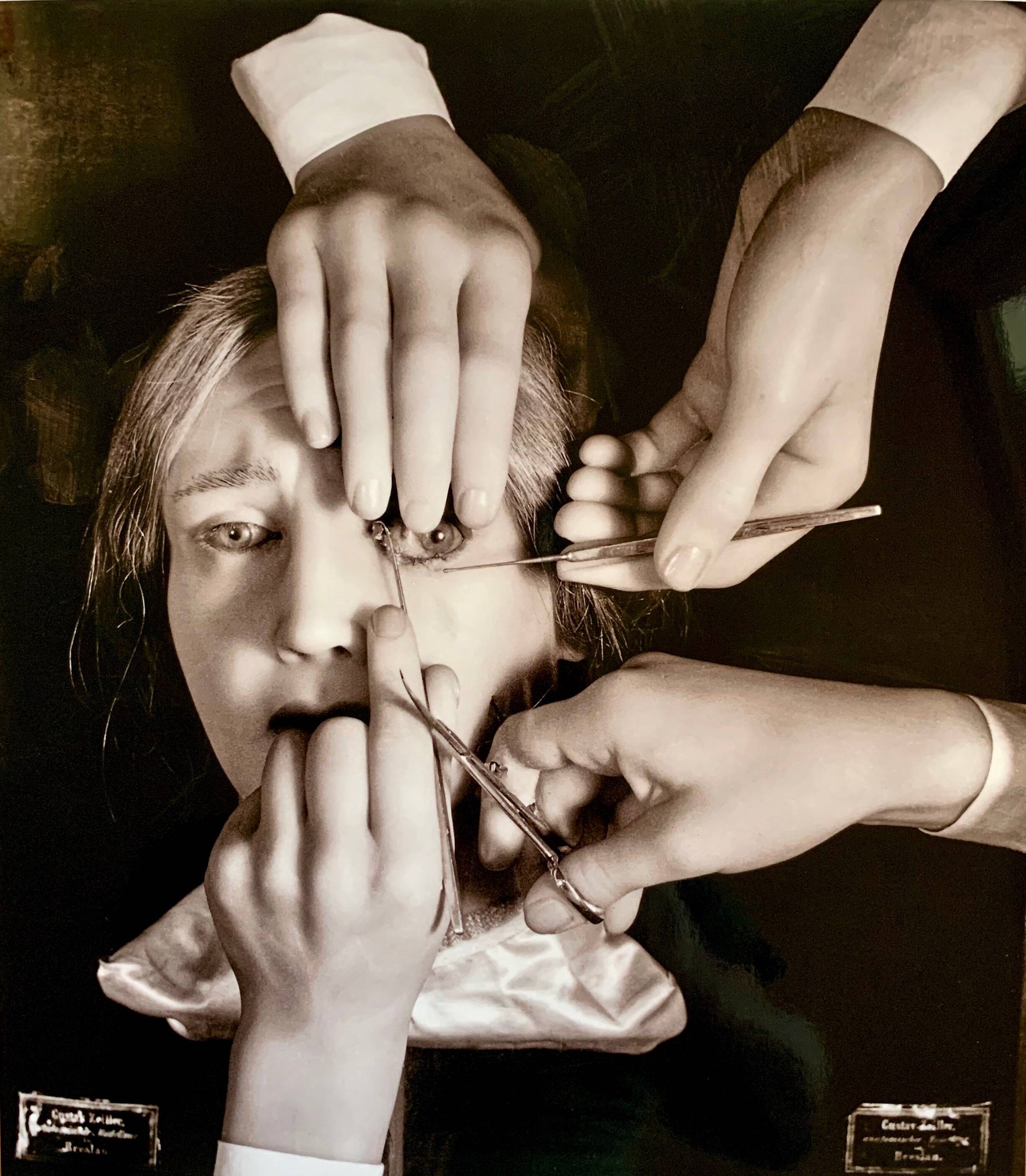 “Schielens Operation (Squint Surgery)” – 1944 Art Photo