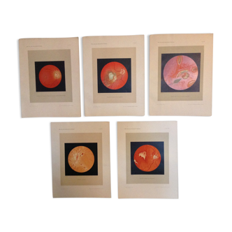 Série de 5 anciennes planches ophtalmologiques lithographiées en couleur de 1924