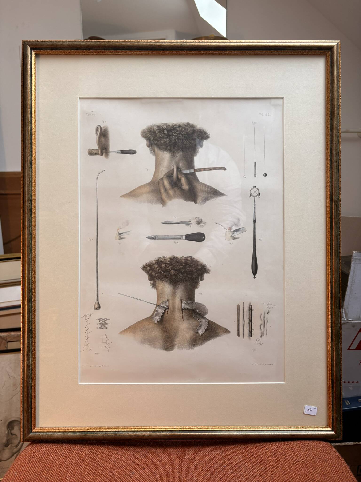 Print Engraving Material Surgery Seton Treatise Anatomy Man BOURGERY