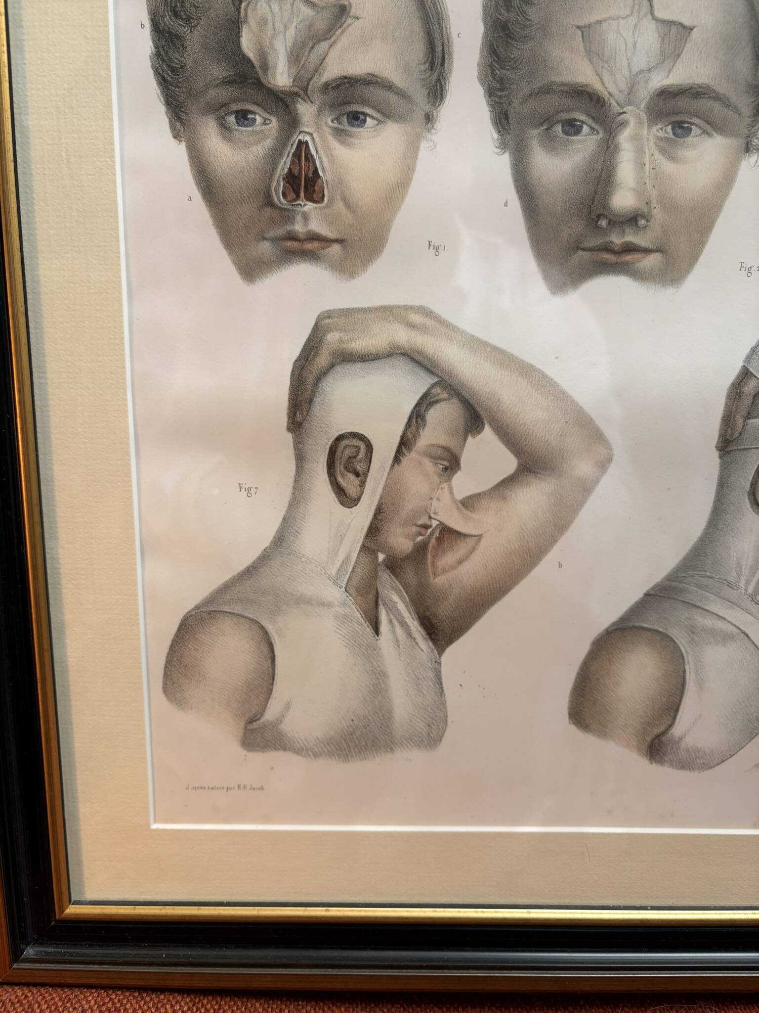 Gravure Plastic Surgery Rhinoplasty NICOLAS Jacob Bourgery Anatomy