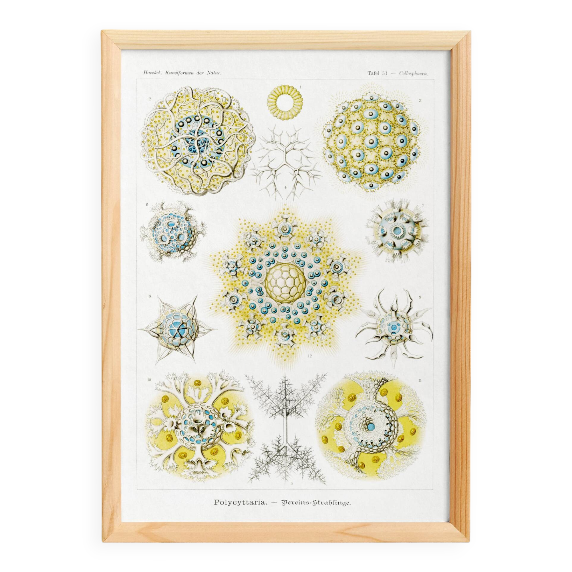 Poster about polycystic kidney stones, based on an old lithograph from 1904.