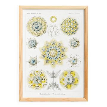 Poster about polycystic kidney stones, based on an old lithograph from 1904.
