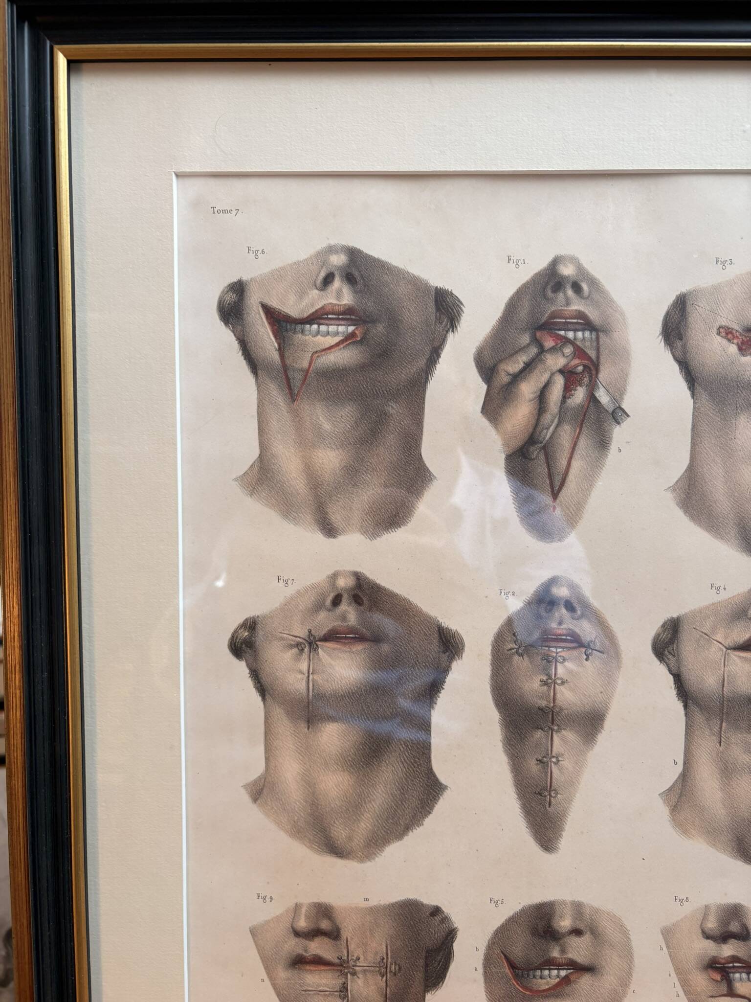 Gravure Cheiloplastic Facial Surgery Anatomy Nicolas Jacob Bourgery