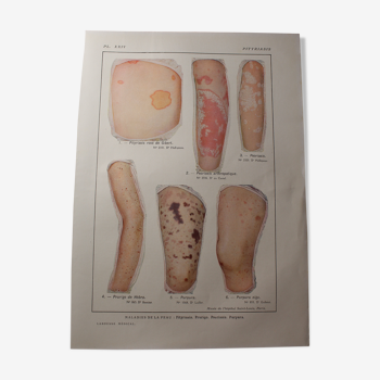 Medical board - anatomy - Pityriasis